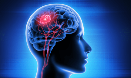 Tumor cerebral: sintomas, diagnóstico e tratamento