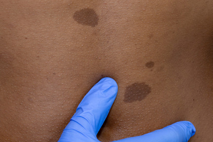 Entenda o que é neurofibromatose, seus tipos, causas e diagnóstico
