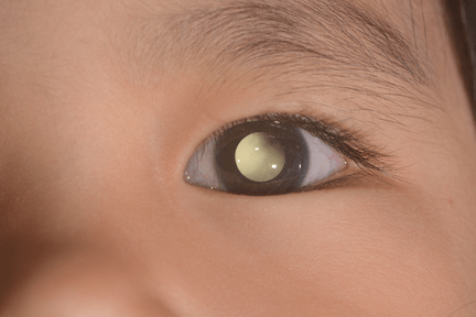 Retinoblastoma: saiba o que é, quais são os sintomas e como diagnosticar